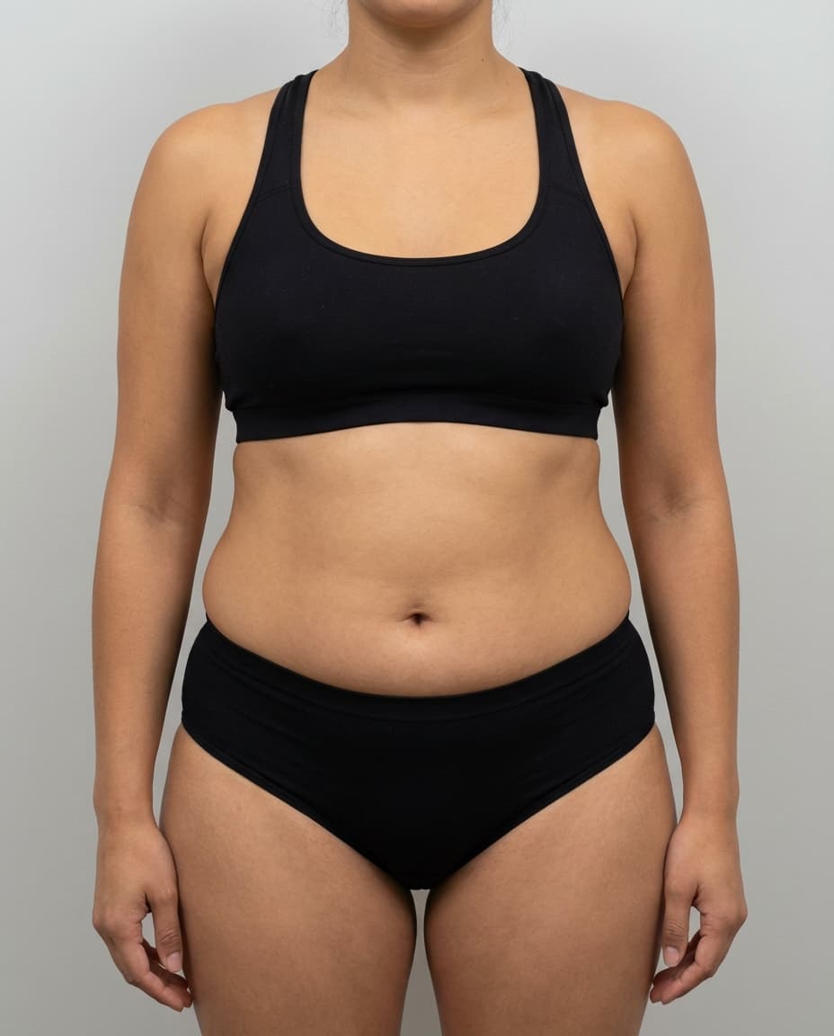 Before Tumescent Liposuction on abdomen — Female patient, age 32