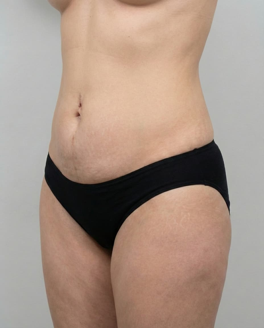 After Tumescent Liposuction on lower abdomen — Female patient, age 44, 7 months post-op