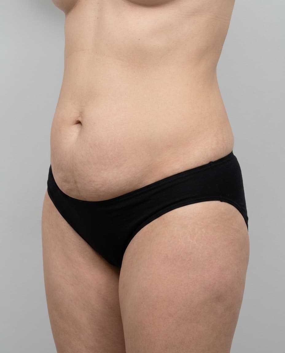 Before Tumescent Liposuction on lower abdomen — Female patient, age 44