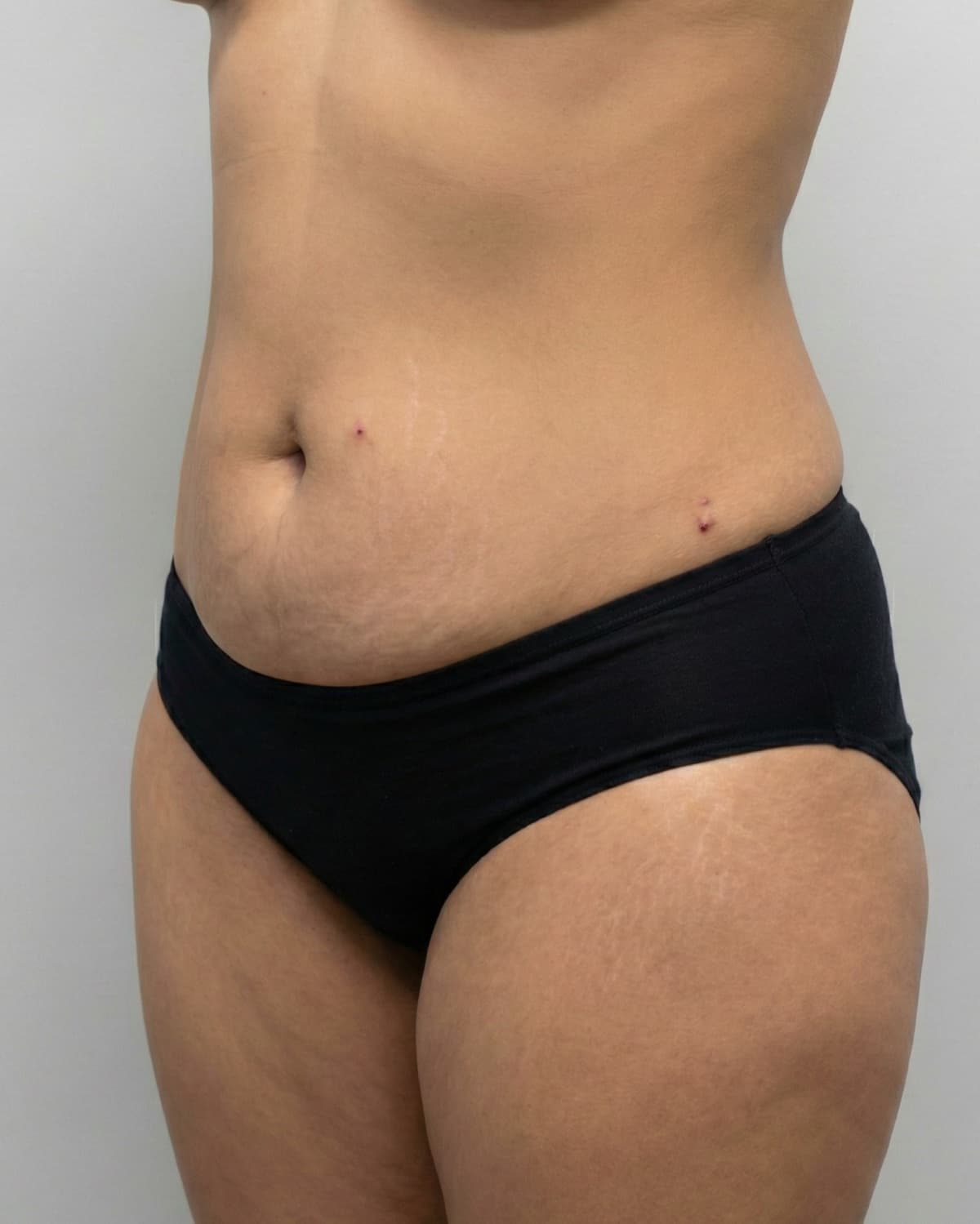 After Tumescent Liposuction on abdomen & flanks — Female patient, age 36, 6 months post-op