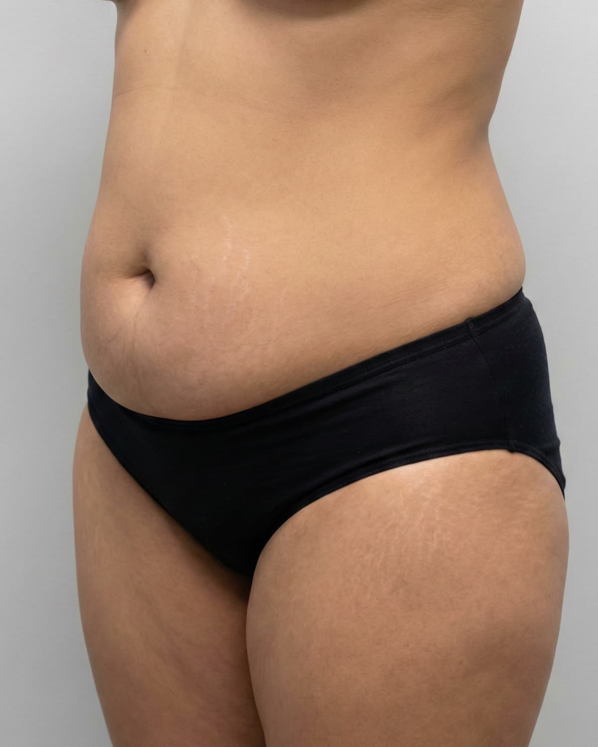 Before Tumescent Liposuction on abdomen & flanks — Female patient, age 36