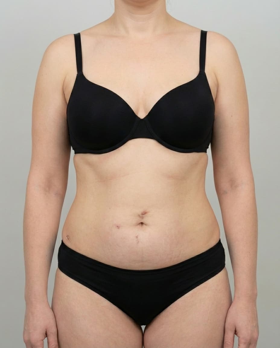 After Tumescent Liposuction on abdomen & flanks — Female patient, age 40, 6 months post-op