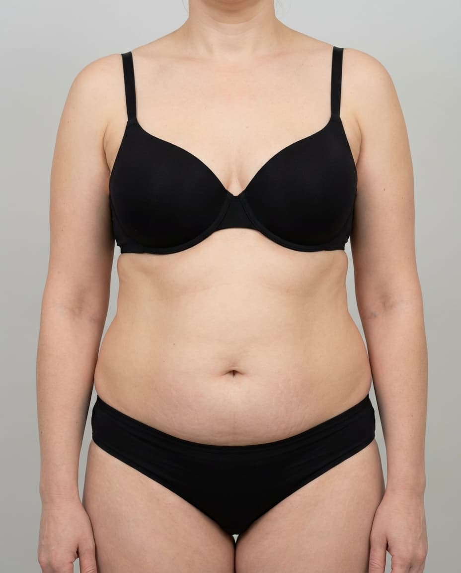 Before Tumescent Liposuction on abdomen & flanks — Female patient, age 40