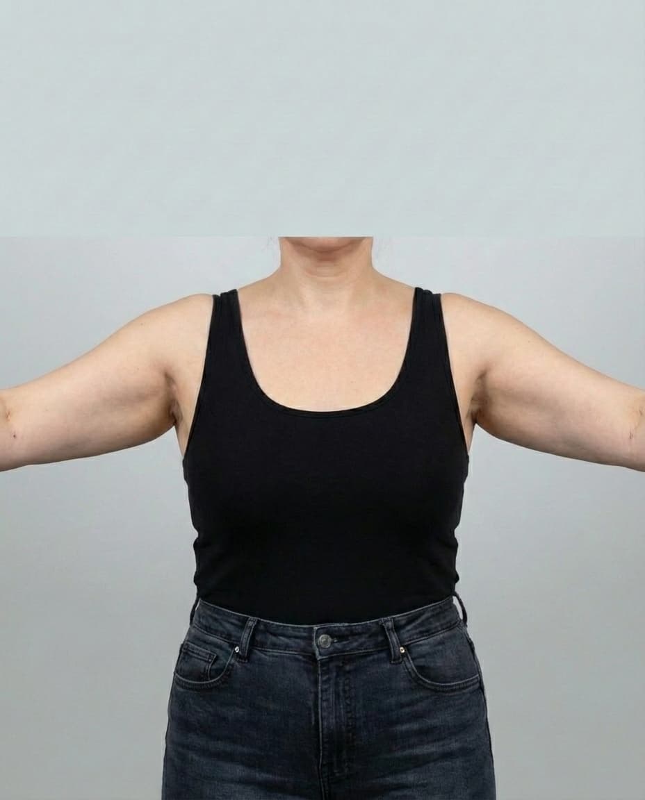 After VASER Liposuction on upper arms — Female patient, age 41, 3 months post-op