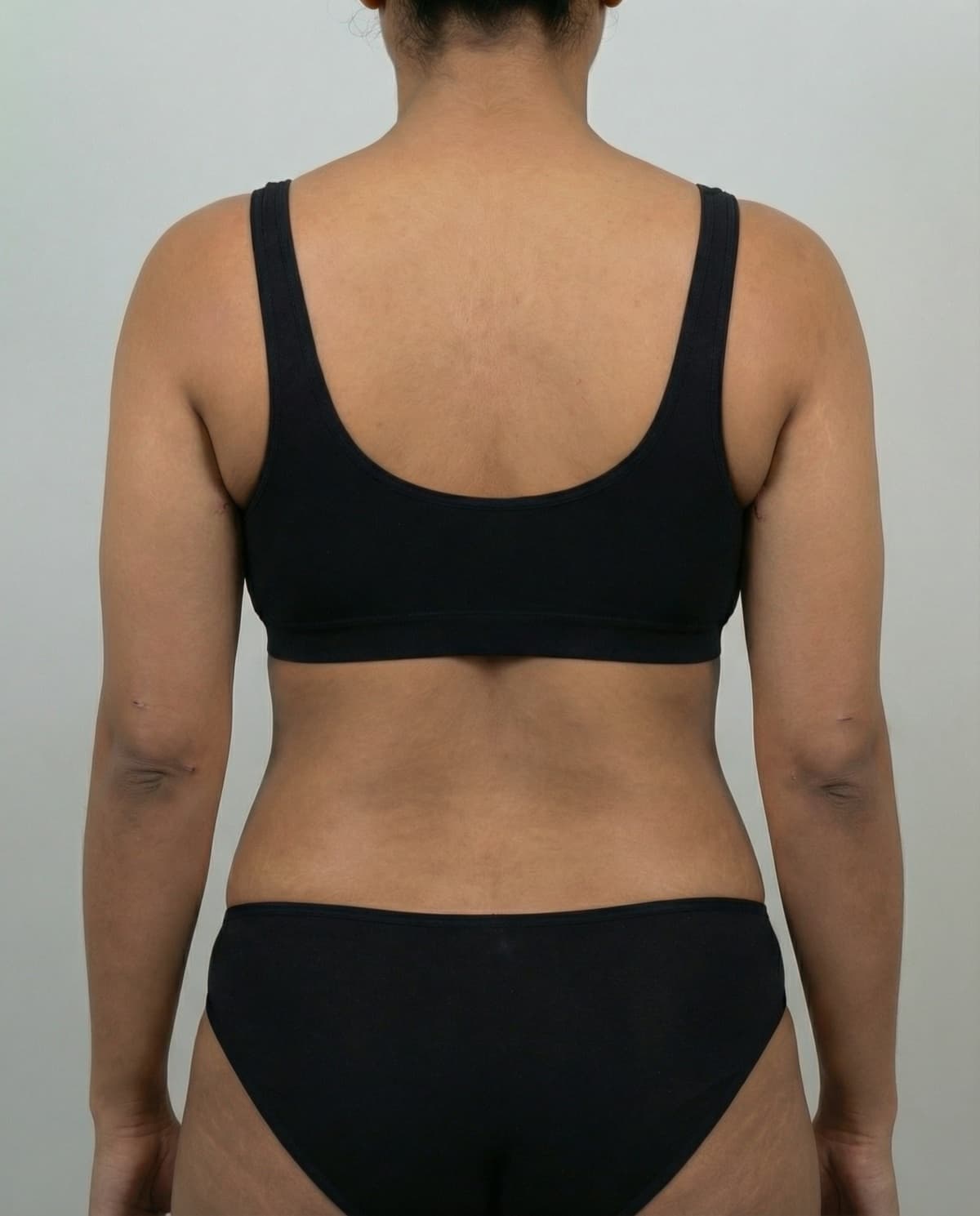 After Laser-Assisted Liposuction on arms & back — Female patient, age 33, 4 months post-op