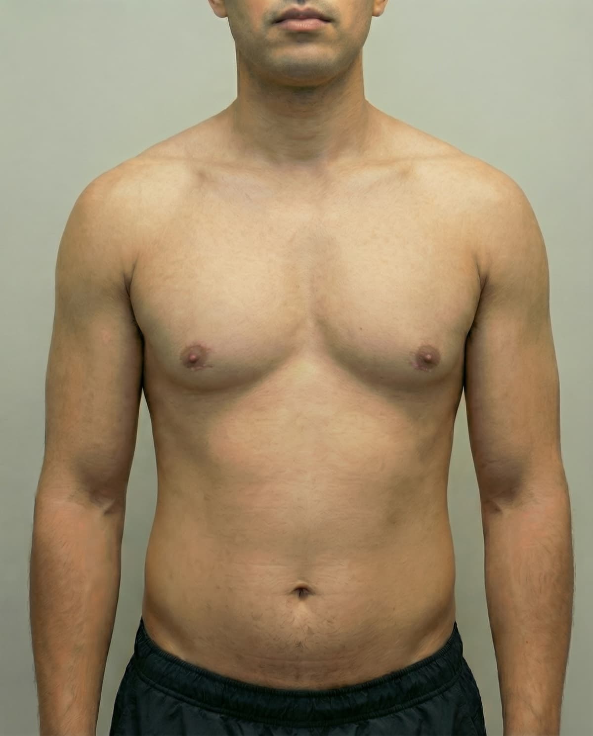 After VASER Liposuction on chest — Male patient, age 28, 7 months post-op