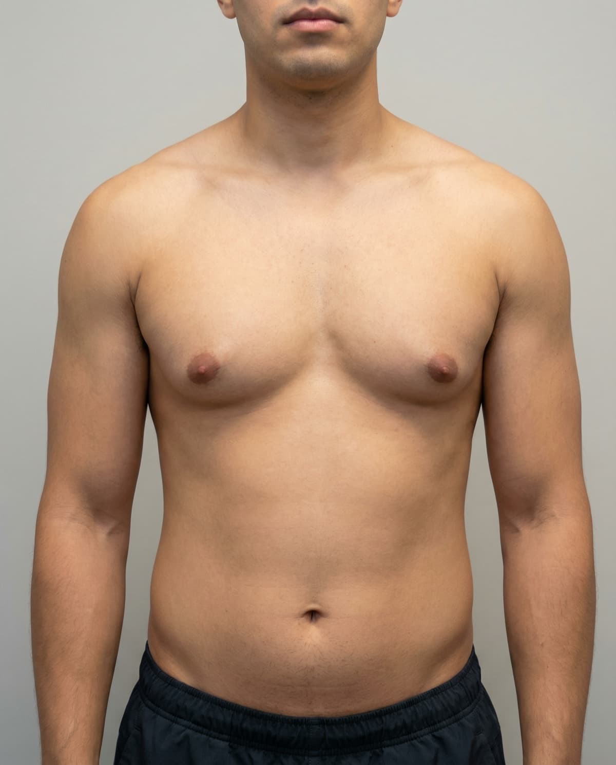 Before VASER Liposuction on chest — Male patient, age 28
