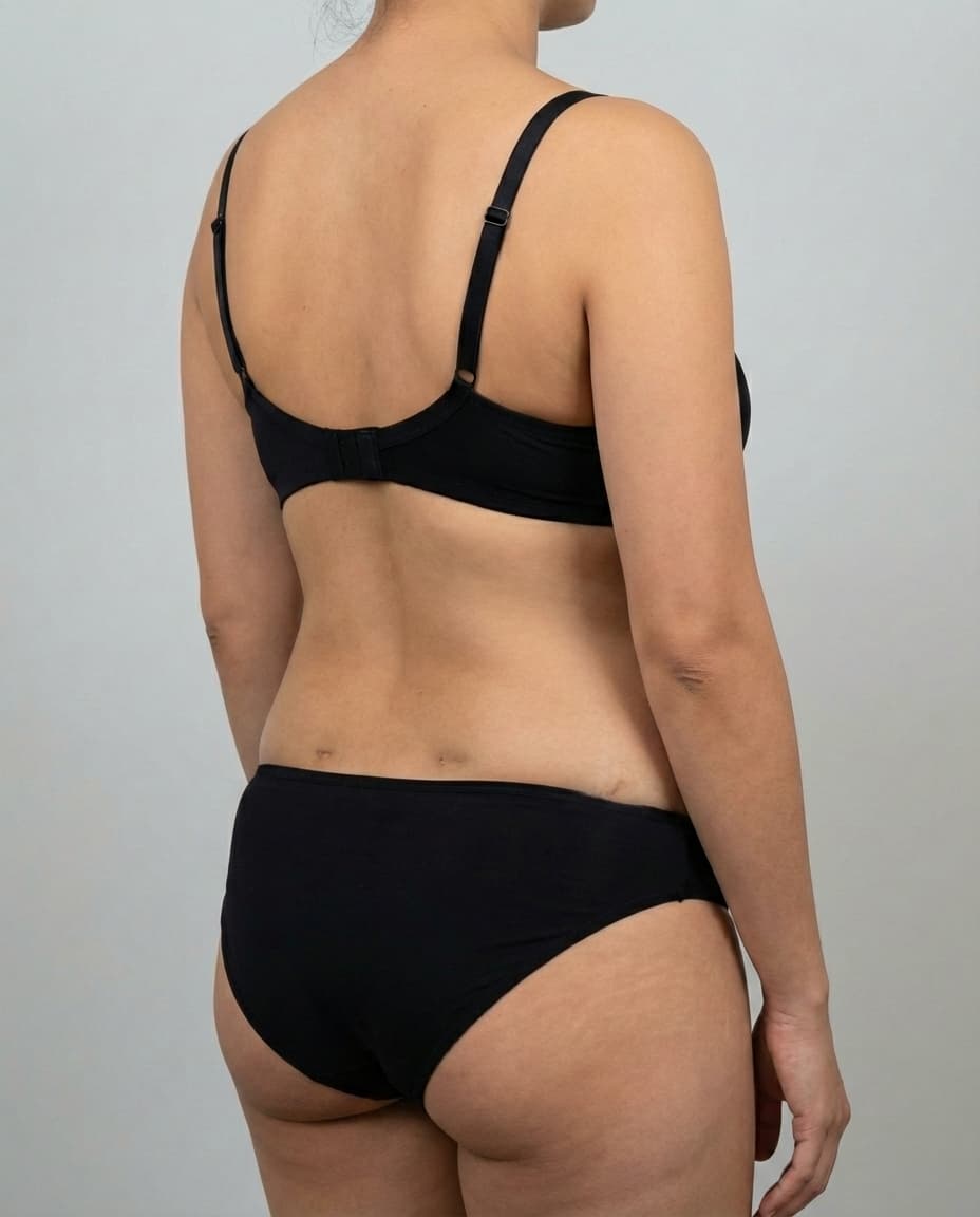 After VASER Liposuction on flanks — Female patient, age 30, 4 months post-op