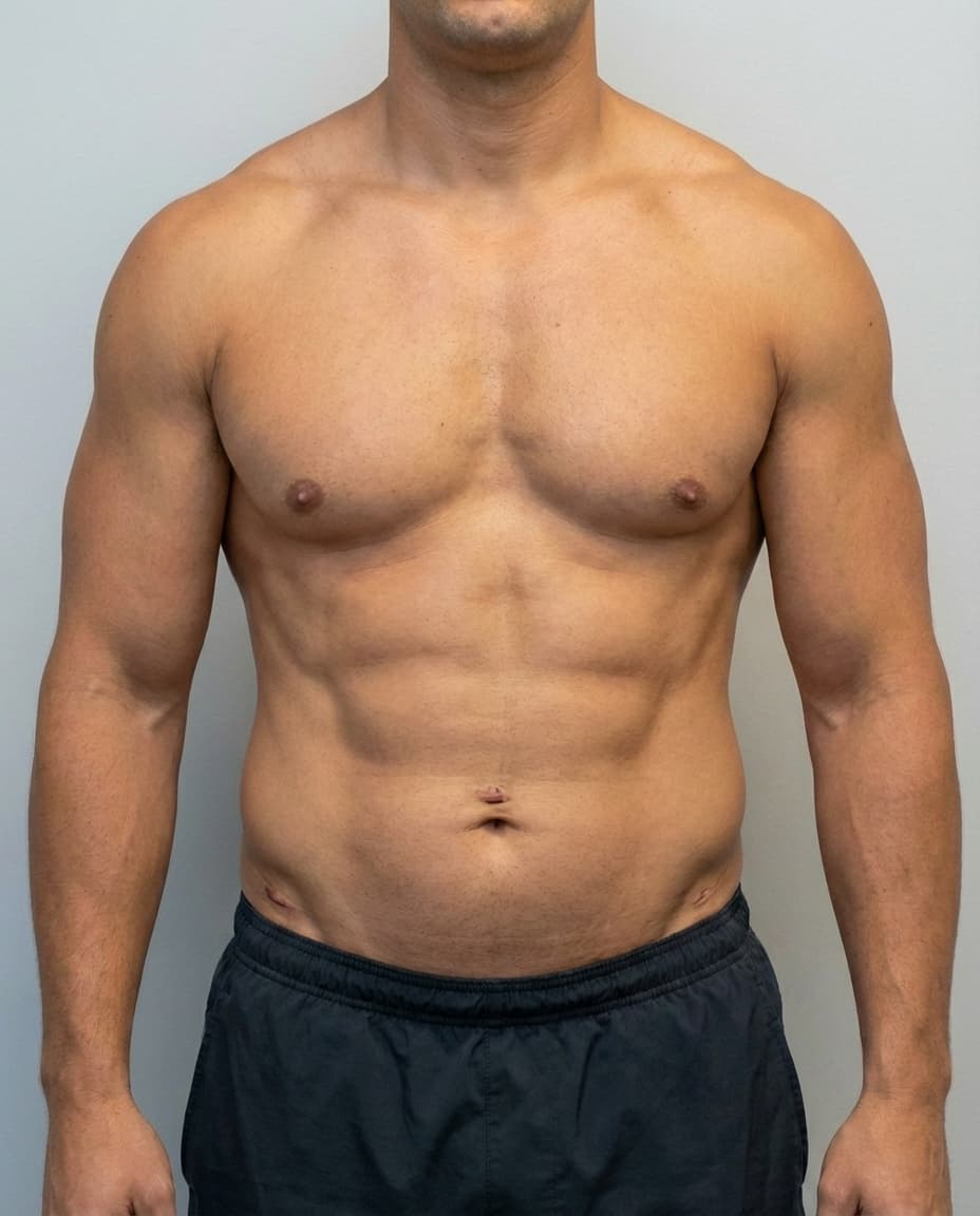 After VASER HD Liposuction on abdomen & flanks & lower back — Male patient, age 35, 9 months post-op