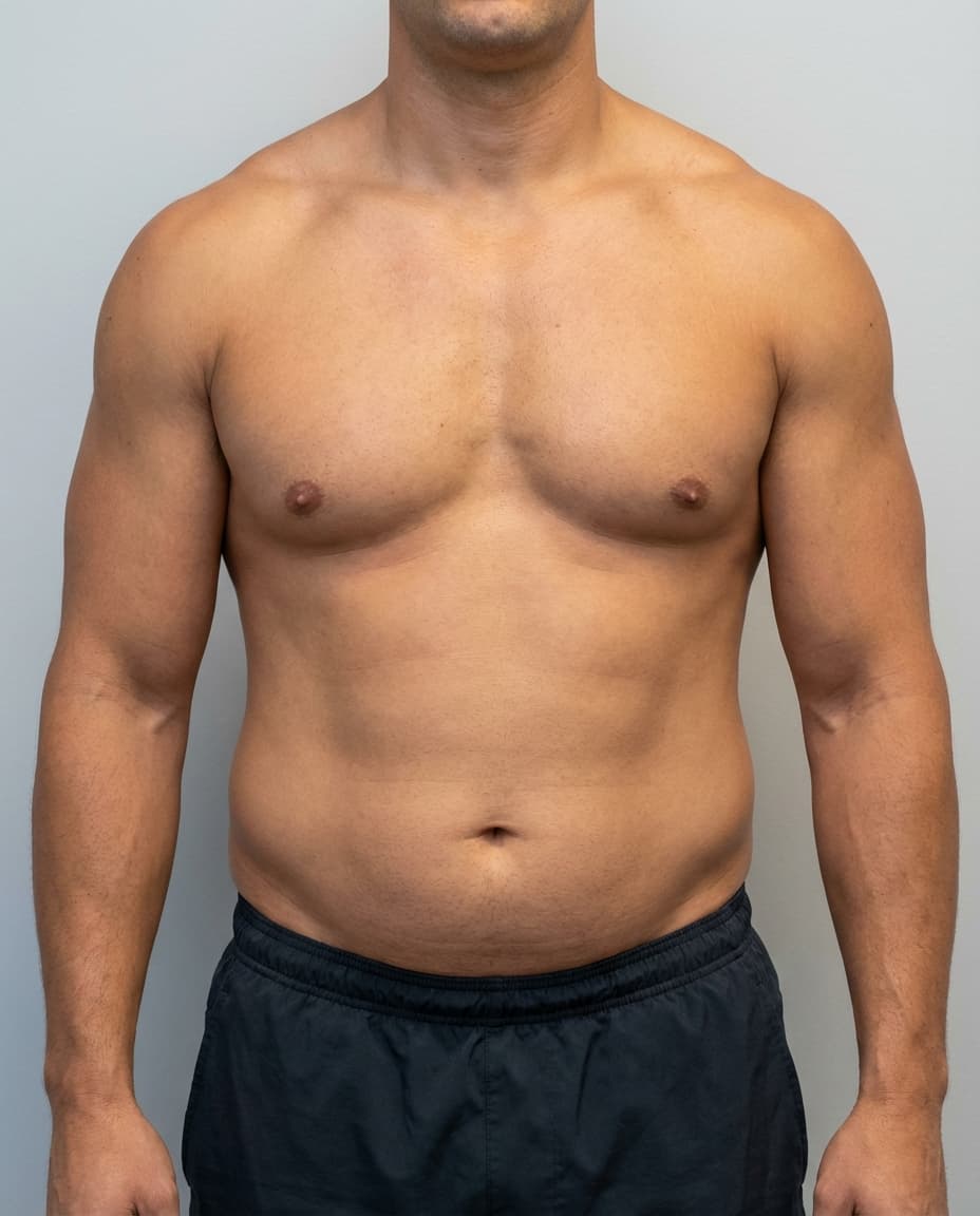 Before VASER HD Liposuction on abdomen & flanks & lower back — Male patient, age 35