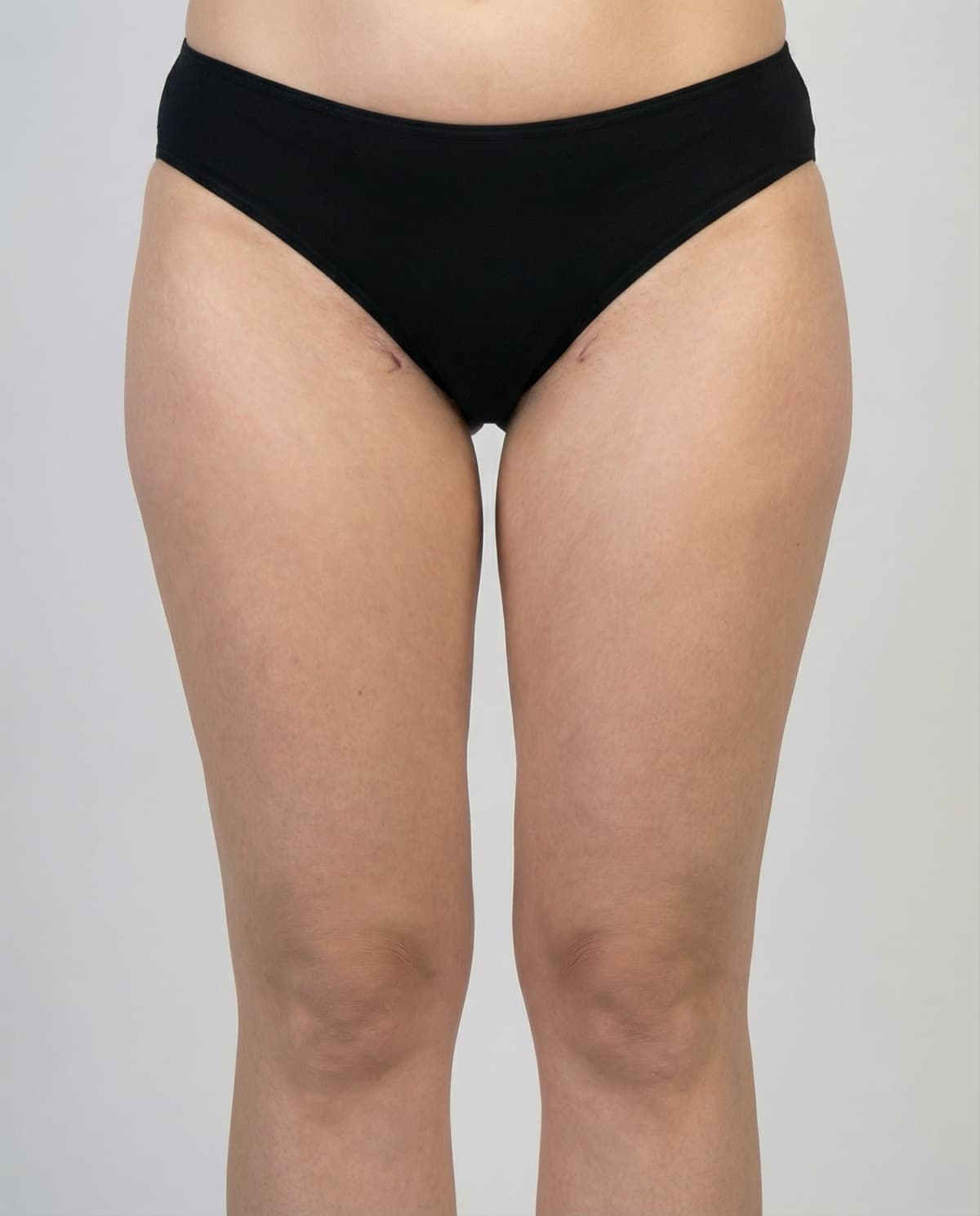 After Tumescent Liposuction on inner thighs & outer thighs — Female patient, age 29, 5 months post-op