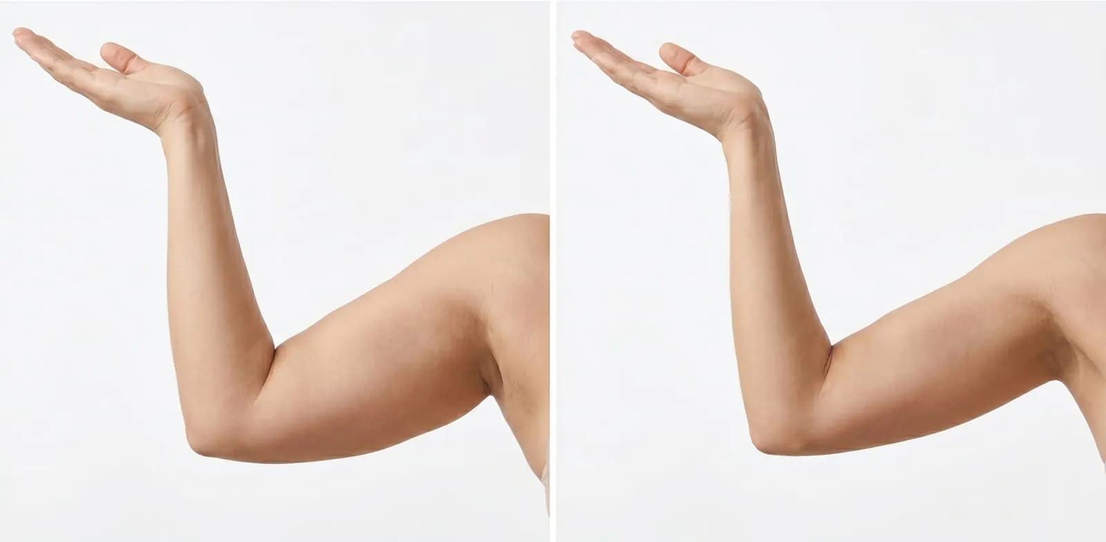arm liposuction before and after results