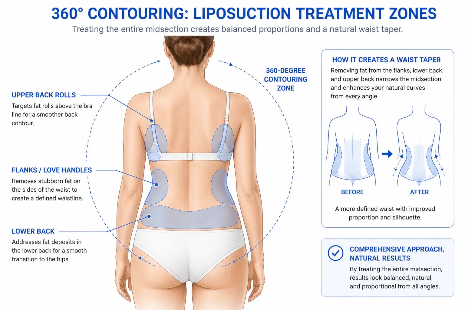 love handle liposuction combined with 360 contouring zones for full waist and hip reshaping