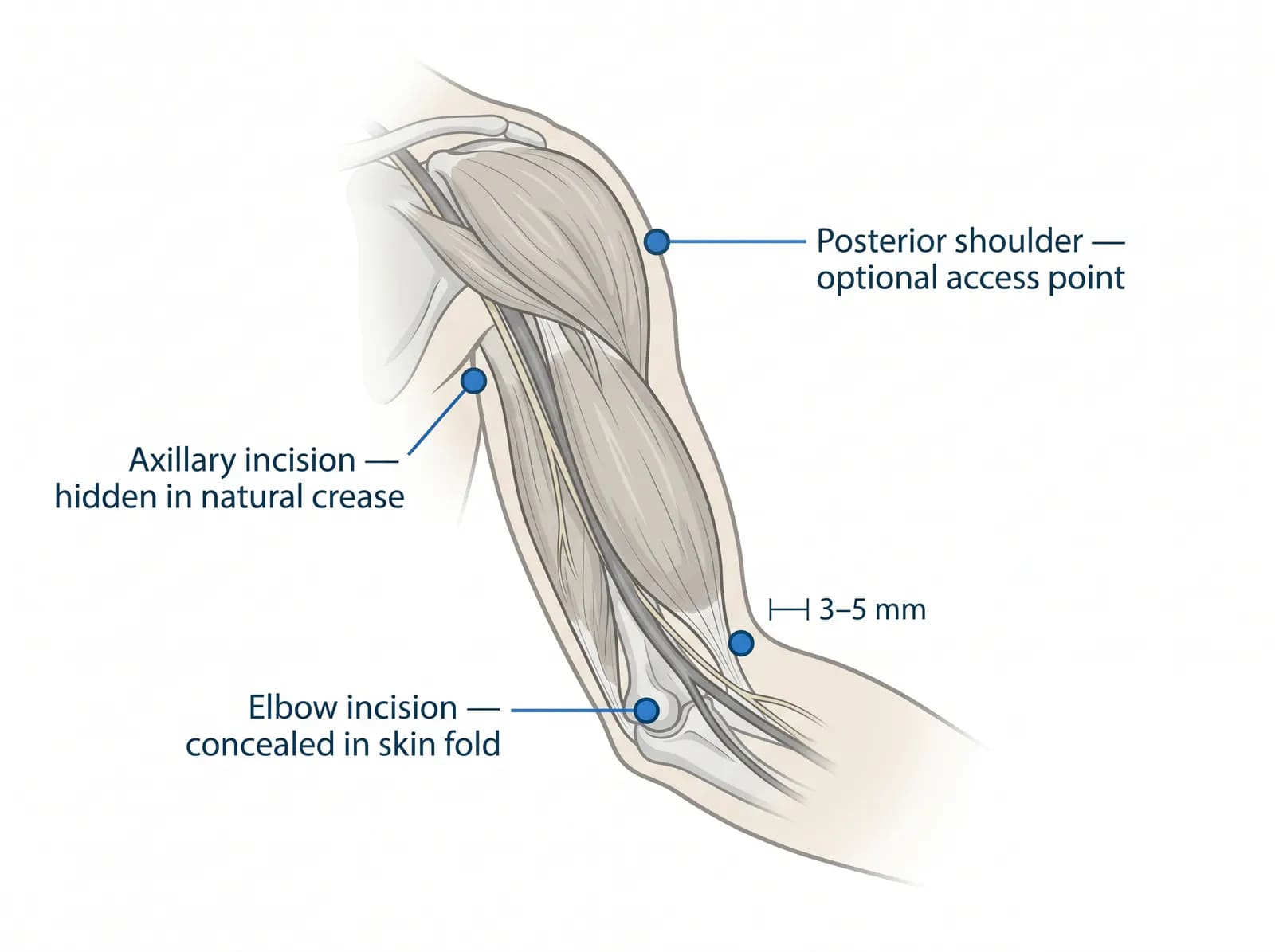 arm liposuction incision placement: small access points at the elbow crease and axilla