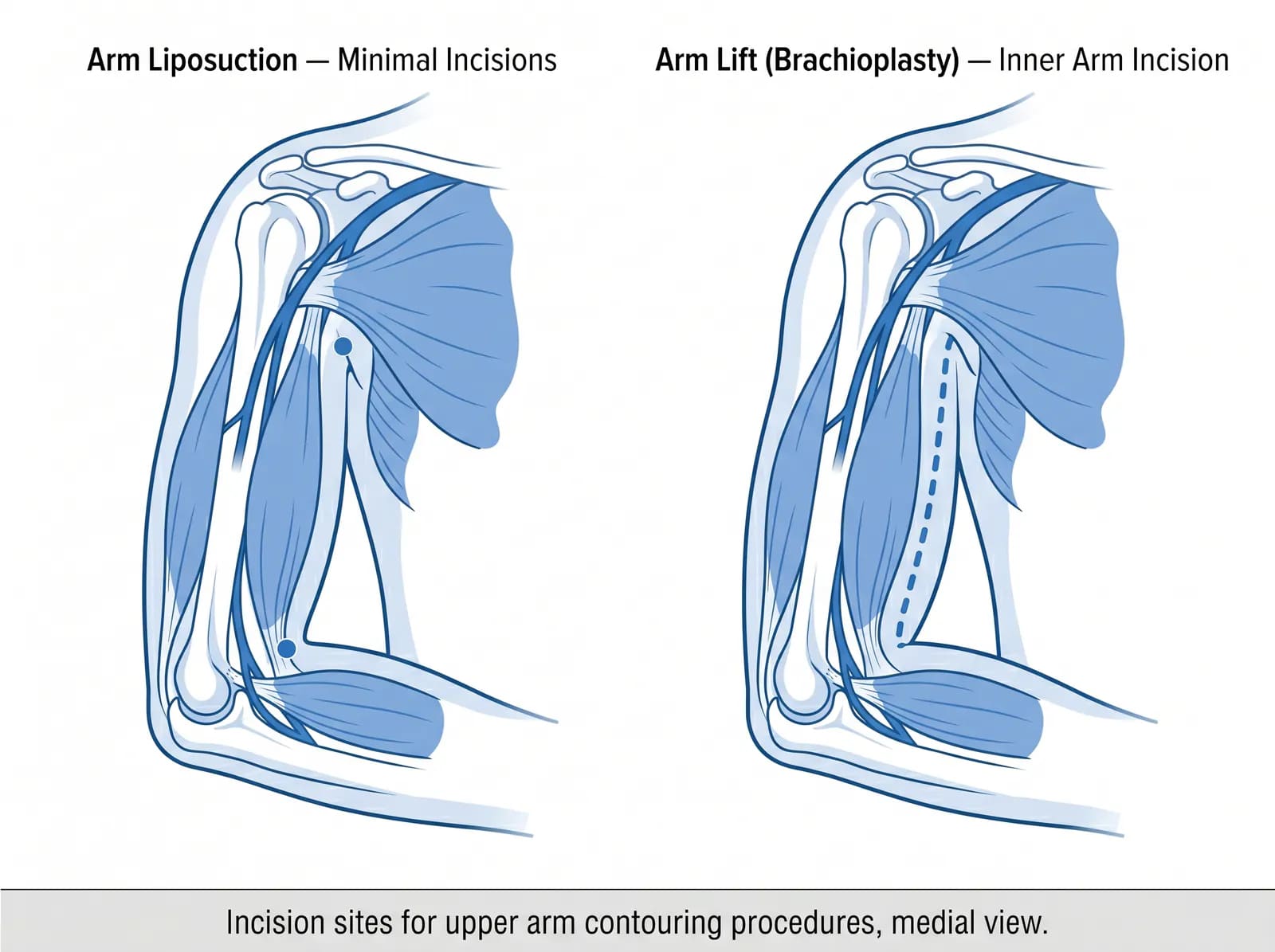 arm liposuction vs brachioplasty arm lift: which procedure addresses bat wings vs loose skin