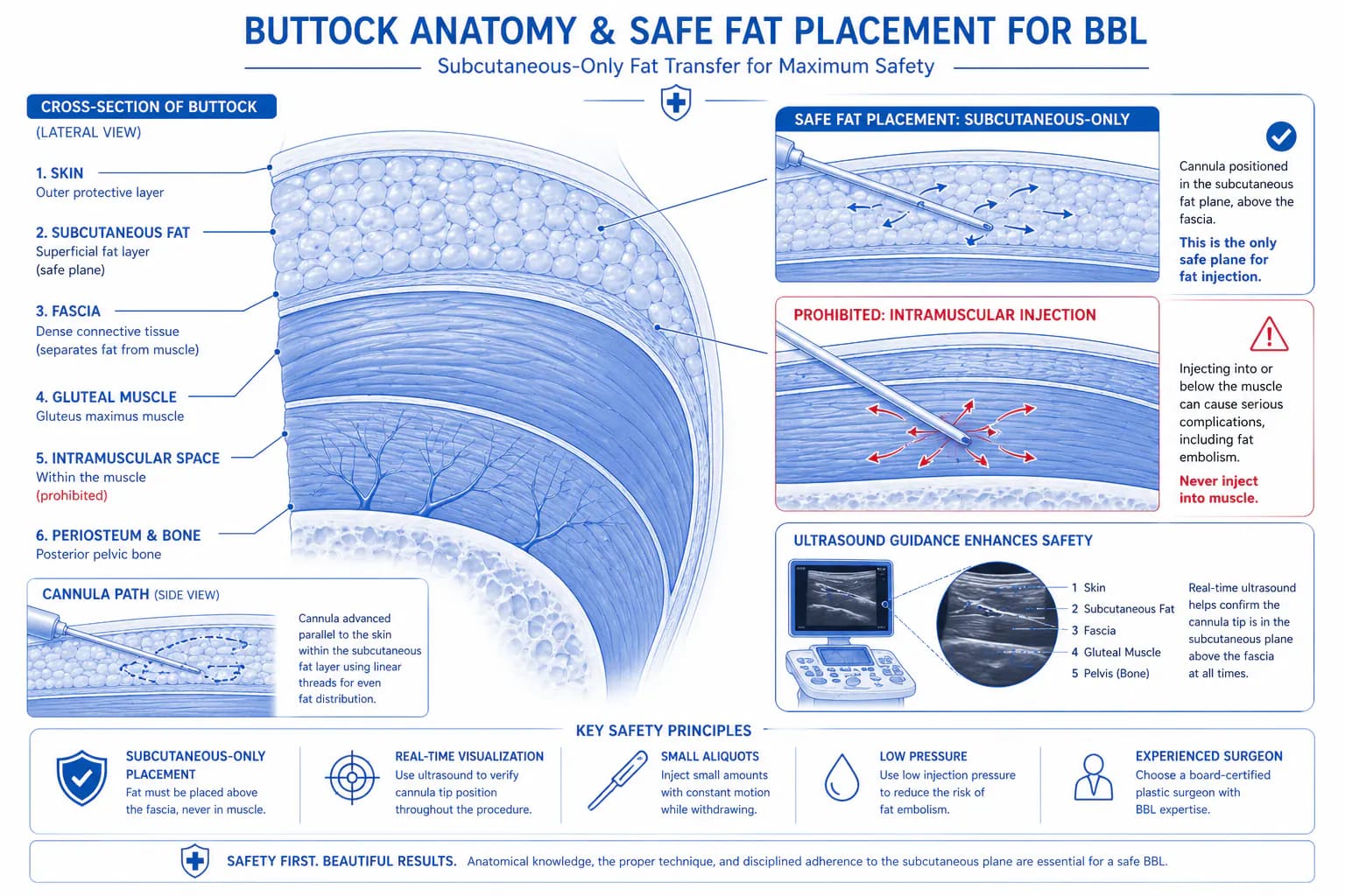 BBL fat injection safety plane: subcutaneous-only technique vs intramuscular zone that causes fatal embolism