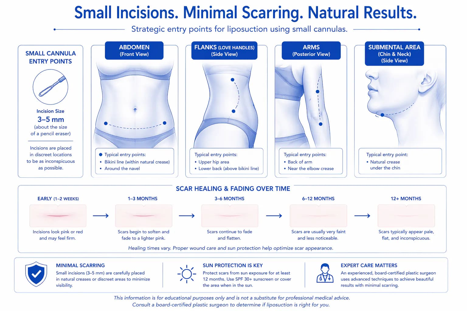 diagram of liposuction cannula entry point locations and resulting scar placement by body area