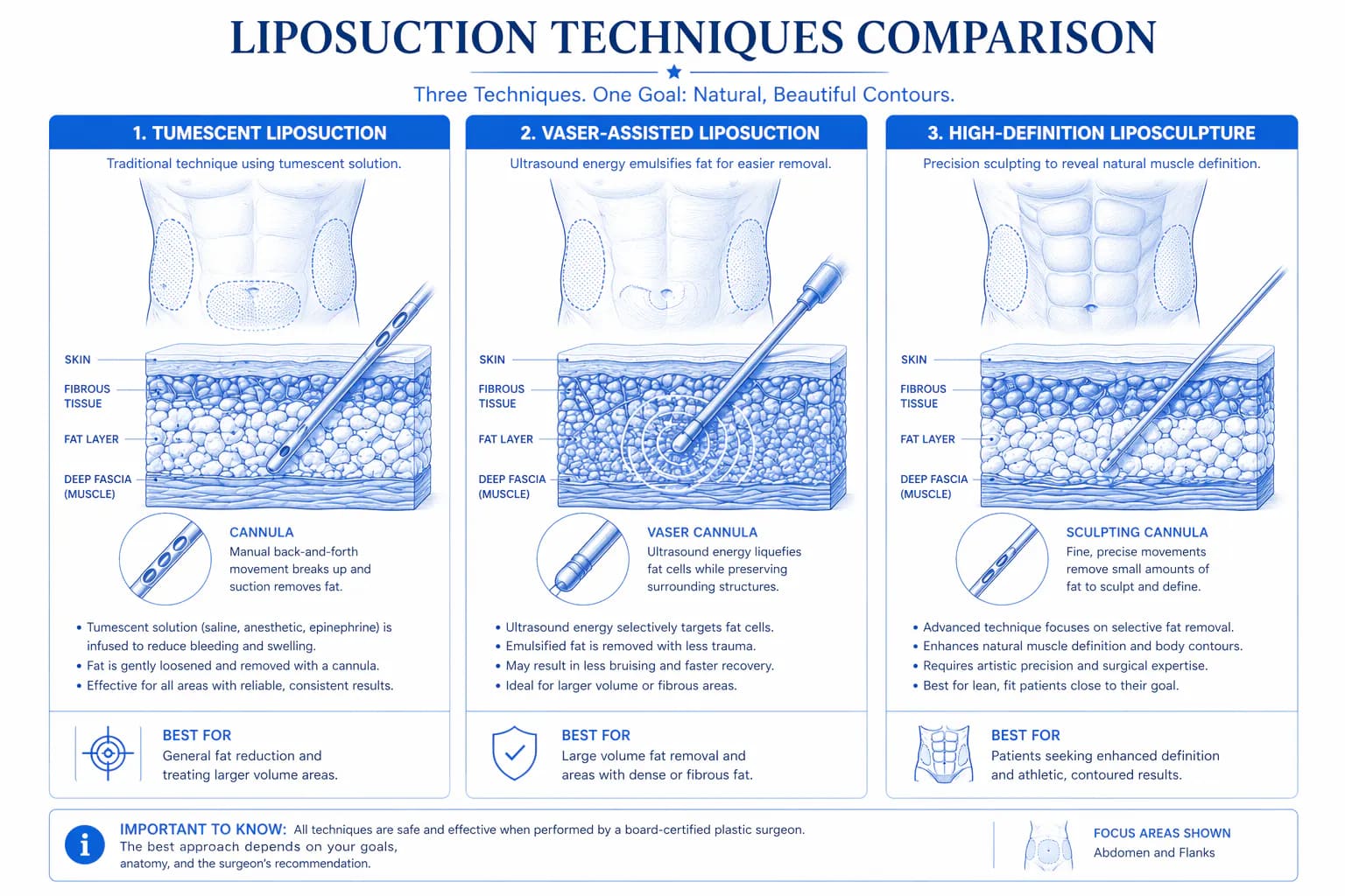 liposuction cannula technique options: standard, PAL, VASER, and laser — matched to fat density and body area