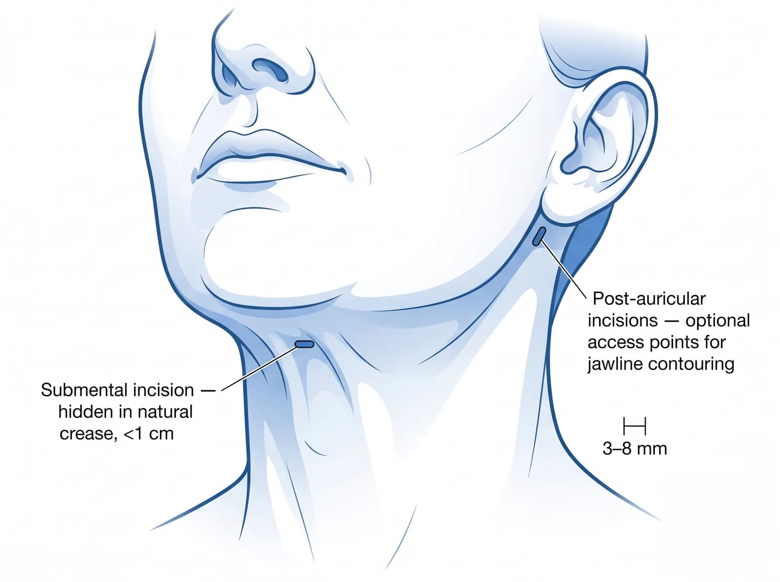 chin liposuction incision placement: 2–3 mm access points under chin and behind earlobes