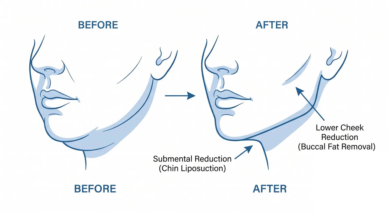 chin liposuction and buccal fat removal combined result: improved jaw definition and neck contour