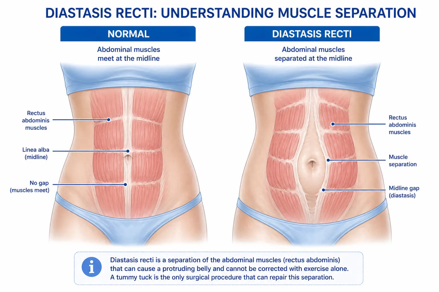 diastasis recti abdominal muscle separation: correctable only with tummy tuck, not liposuction