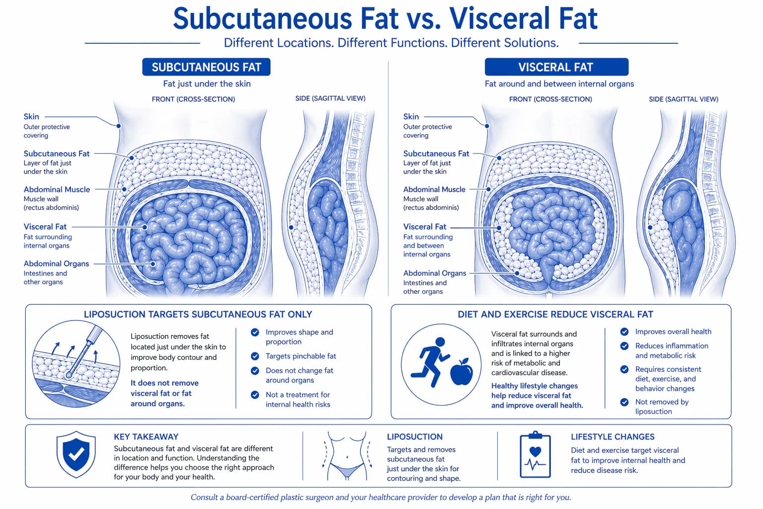 Diagram comparing subcutaneous fat (treatable by liposuction) versus visceral fat (not treatable) — cross-section of the abdomen showing fat layer locations
