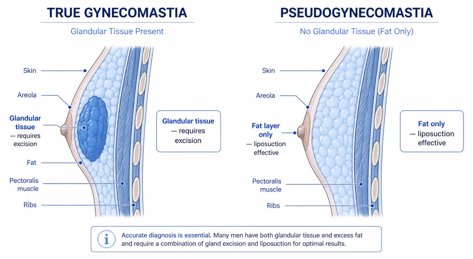 true gynecomastia vs pseudogynecomastia: how to tell them apart and why it determines treatment