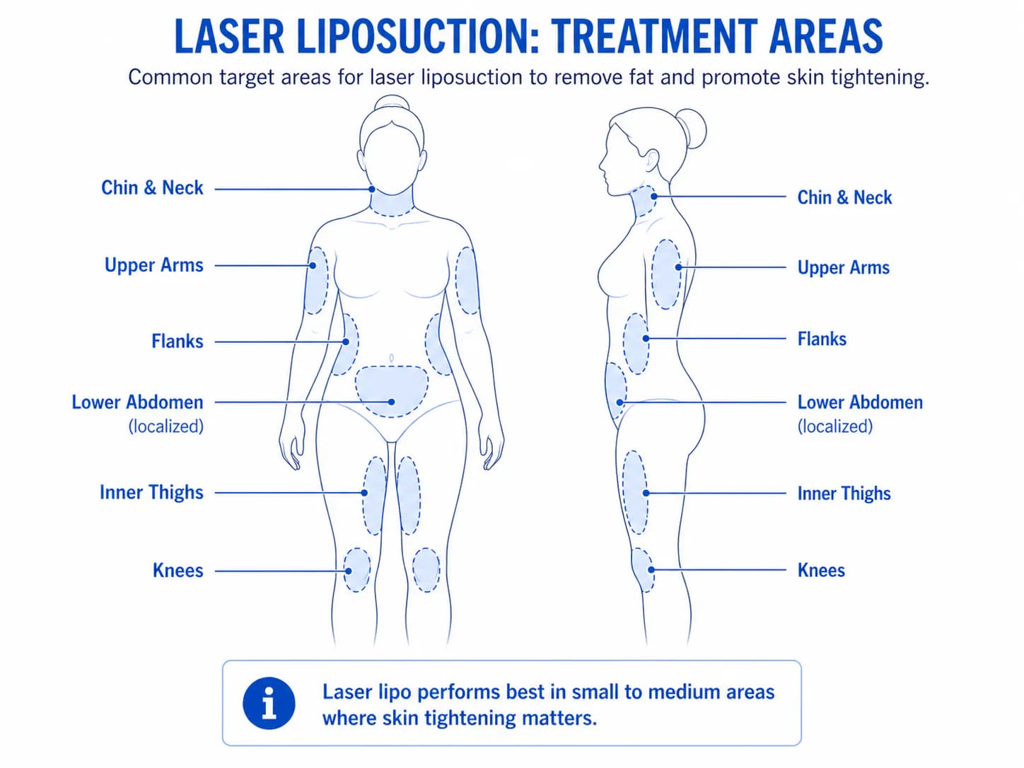 best body areas for laser liposuction: chin, arms, inner thighs, and flanks where skin tightening helps
