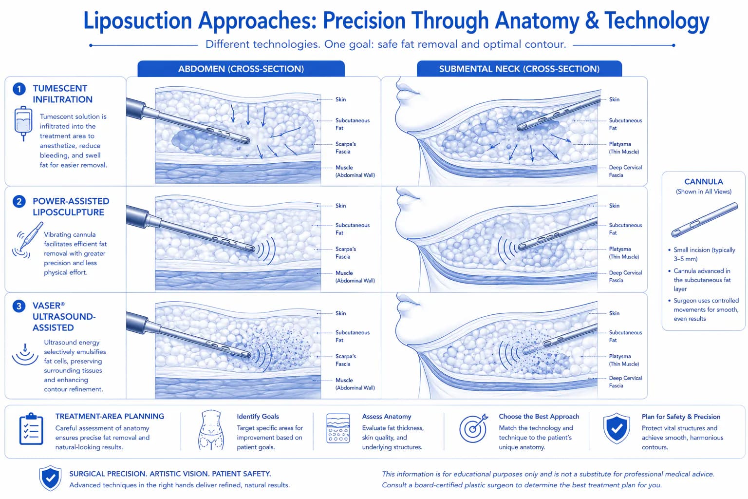 liposuction technique anatomy: tumescent fluid, cannula movement, and fat layer targeting in cross-section