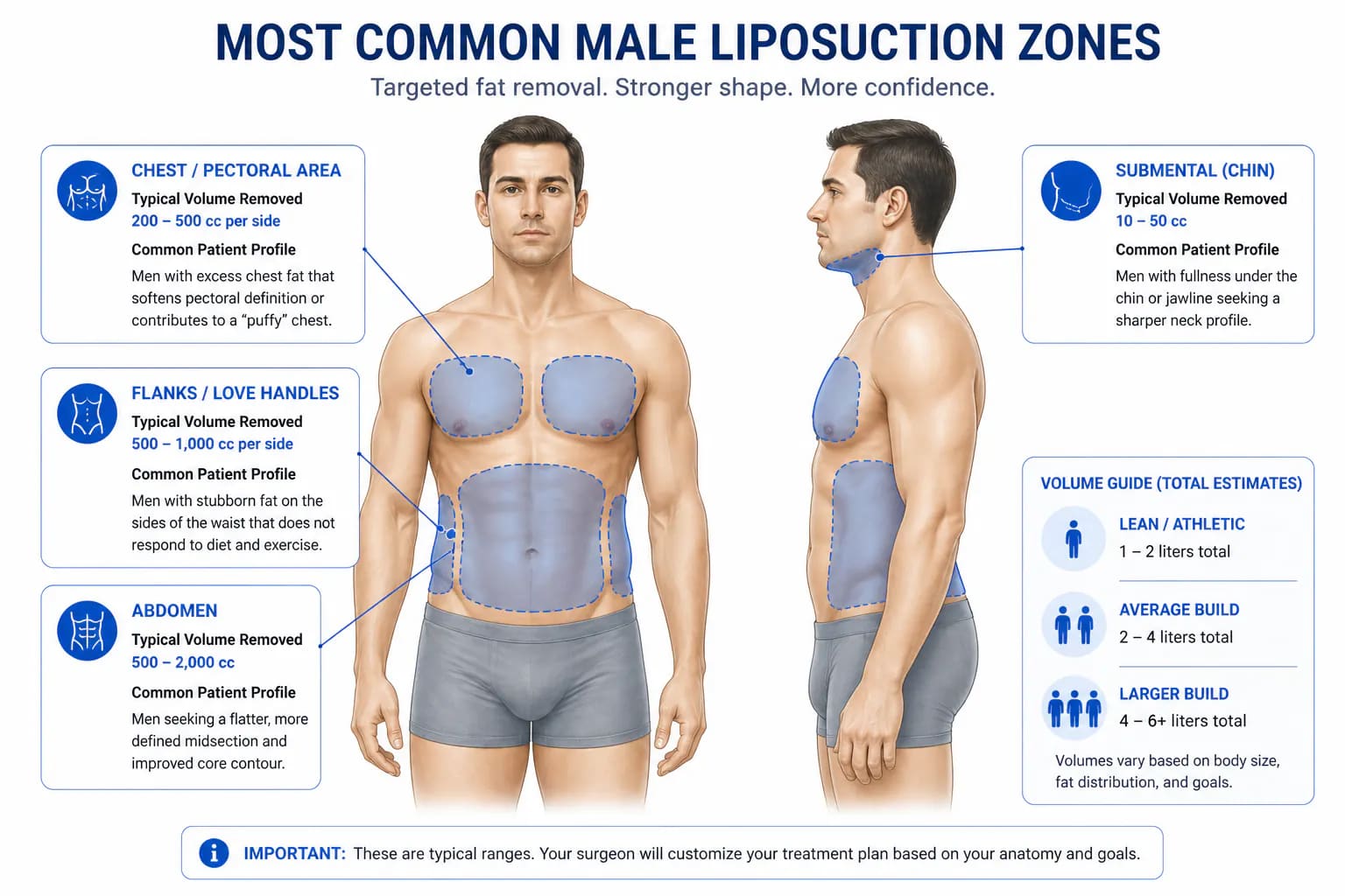 male liposuction treatment zones: chest, abdomen, flanks, waist, and back contouring areas