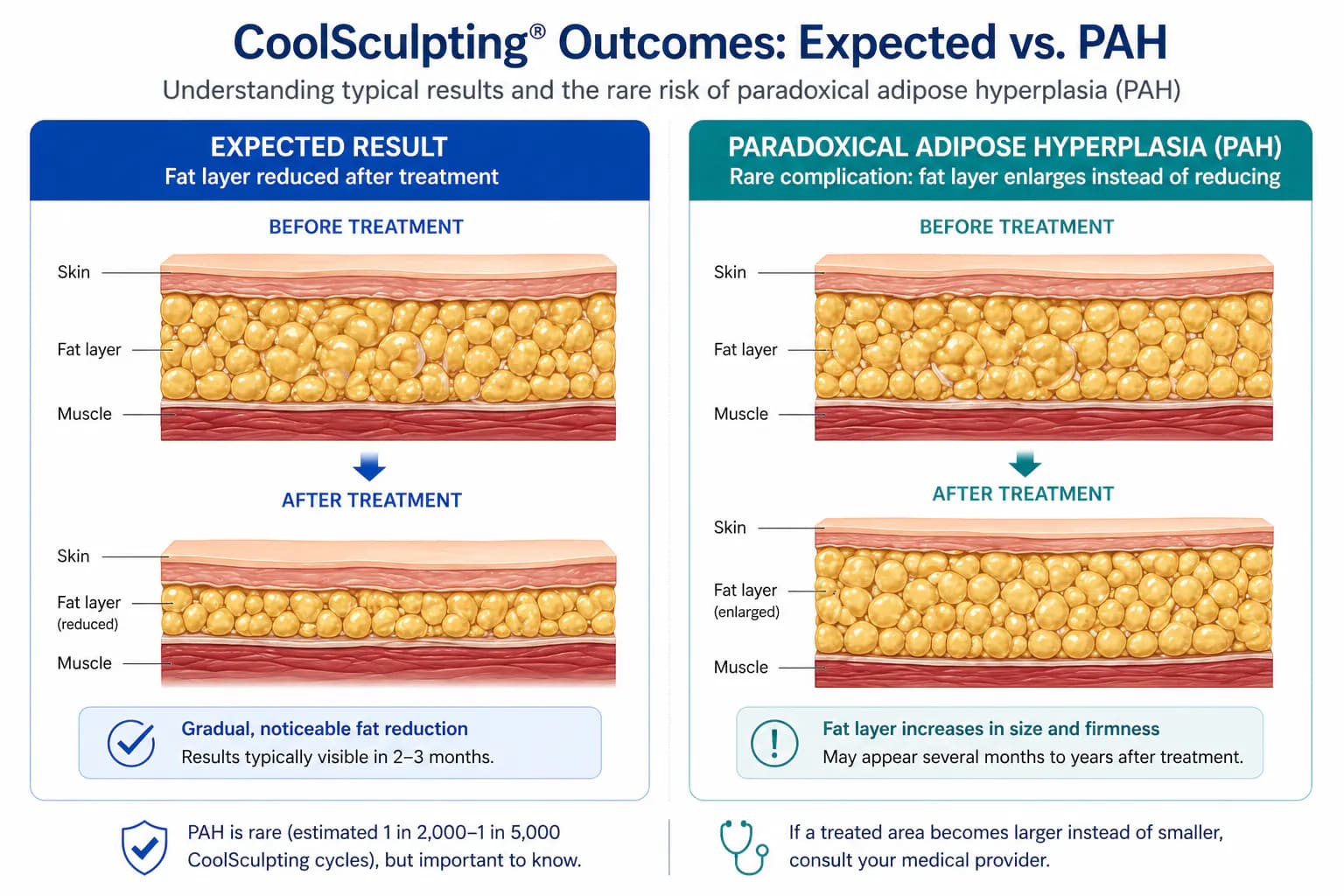 paradoxical adipose hyperplasia (PAH): CoolSculpting complication where treated fat grows larger instead of shrinking