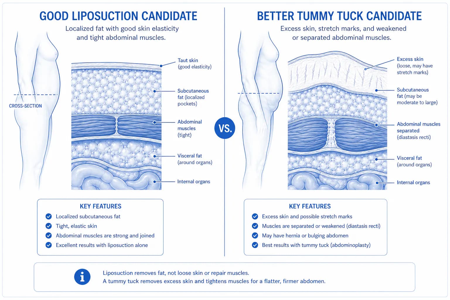 stomach liposuction ideal candidate: good skin elasticity, localized subcutaneous fat, stable weight