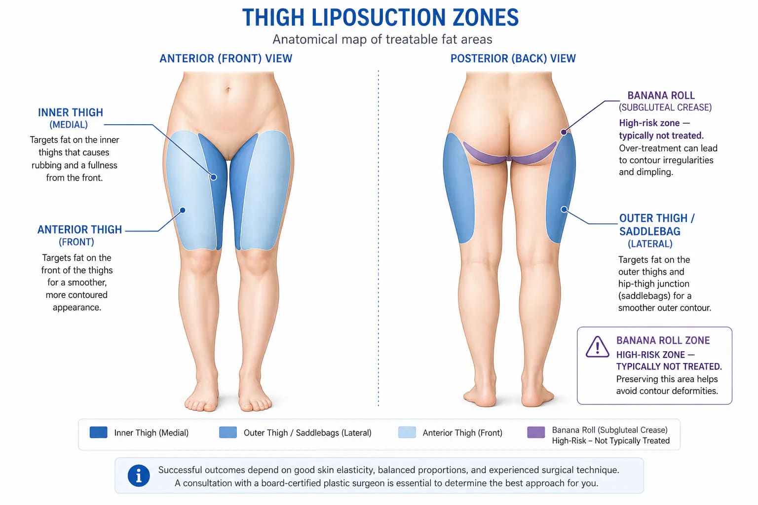 thigh liposuction treatment zones: inner thigh, outer thigh saddlebags, anterior thigh, and banana roll