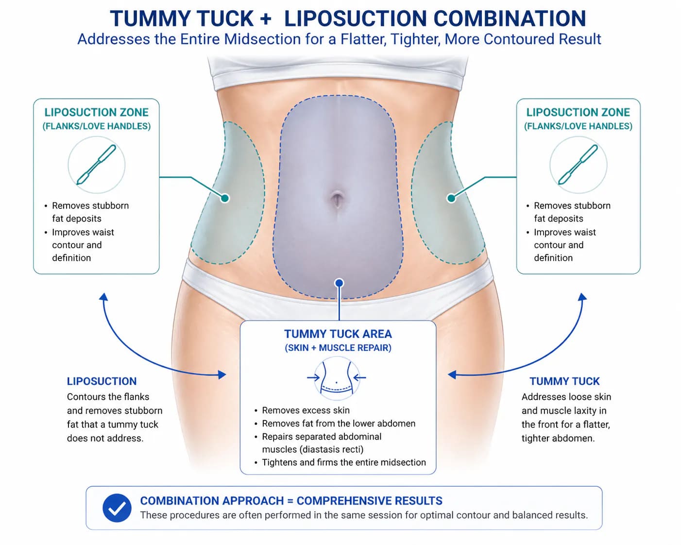 combined liposuction and tummy tuck procedure diagram: fat removal with skin excision and muscle repair