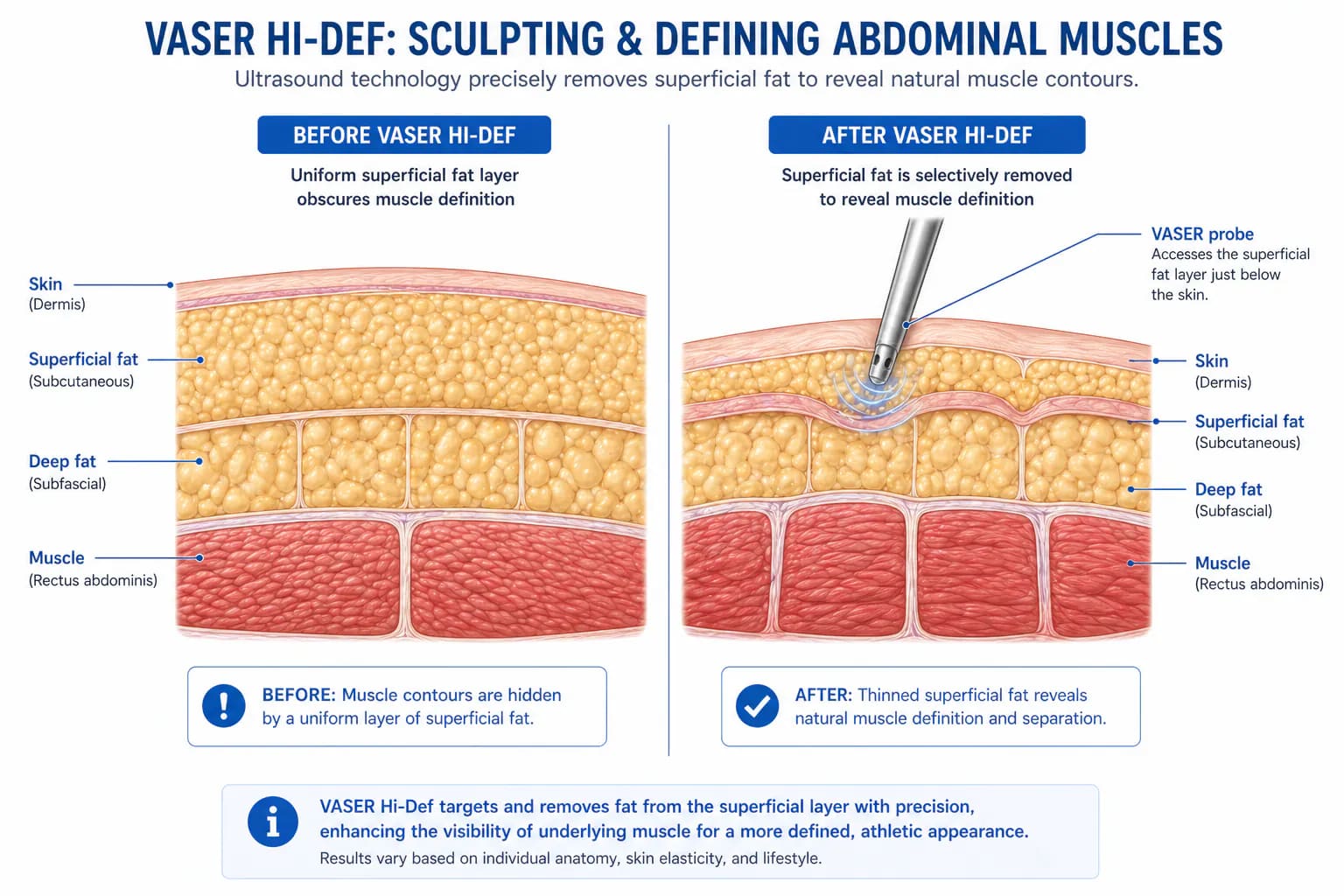 VASER Hi-Def liposuction abdominal etching: enhanced muscle definition result in a low-body-fat candidate
