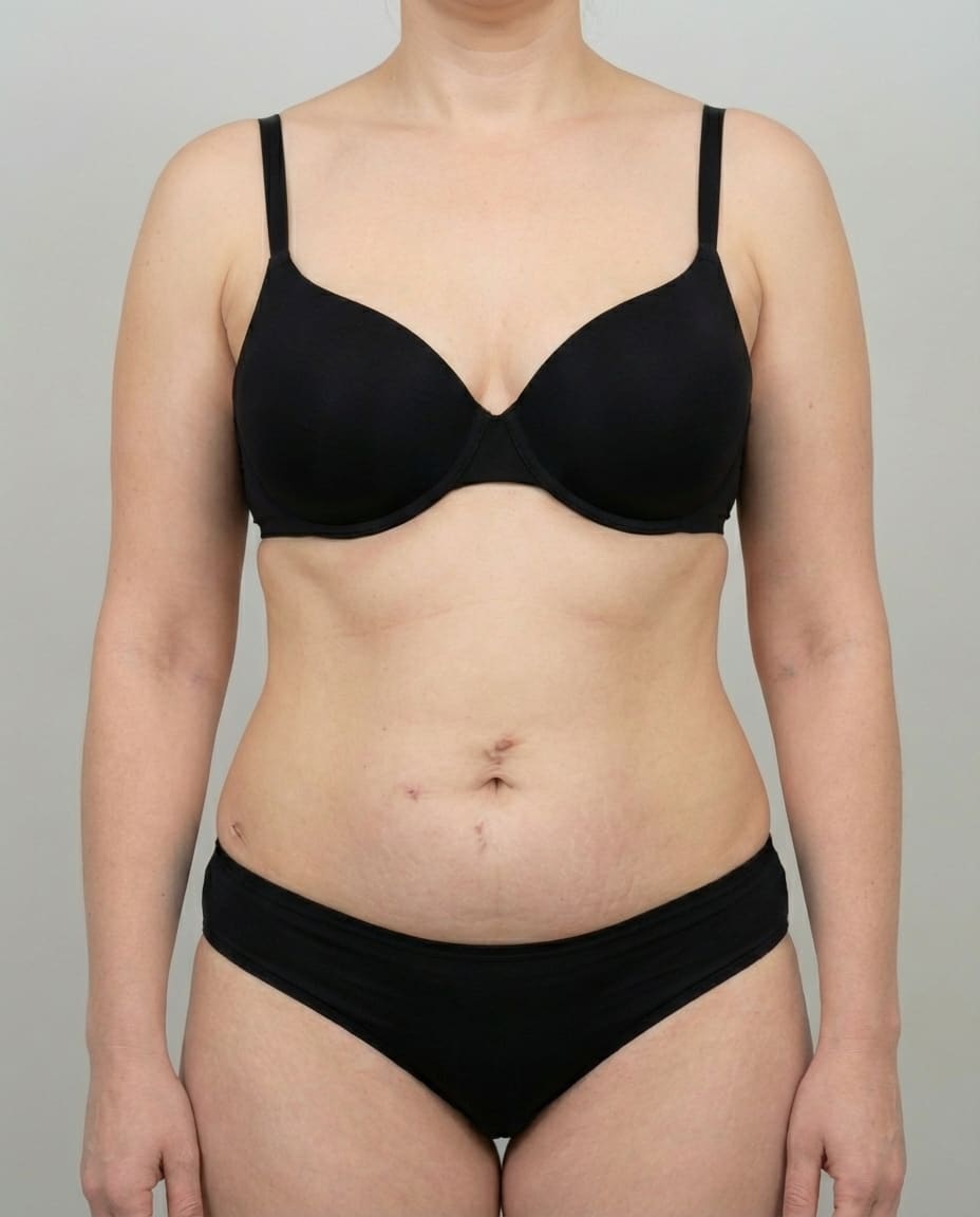 After Tumescent Liposuction on abdomen & flanks — Female patient, age 40, 6 months post-op