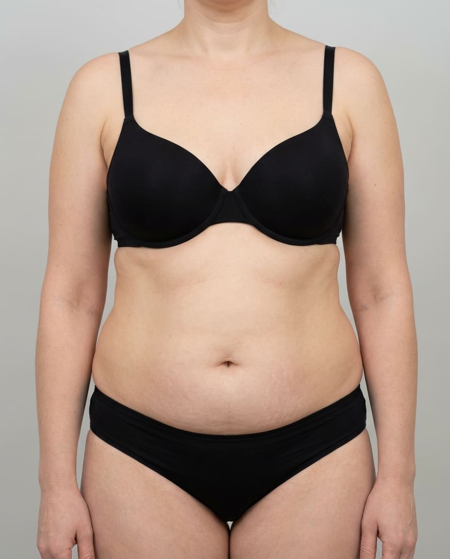 Before Tumescent Liposuction on abdomen & flanks — Female patient, age 40