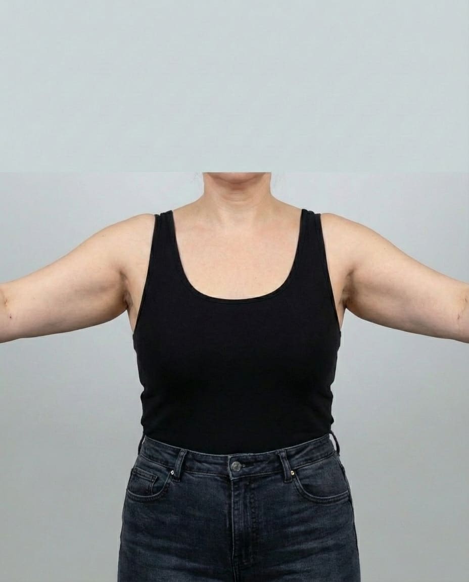 After VASER Liposuction on upper arms — Female patient, age 41, 3 months post-op